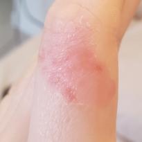 How the burn looks a week and a half later.